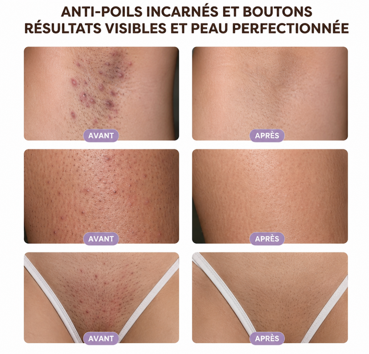 Pads Anti Poils Incarnés